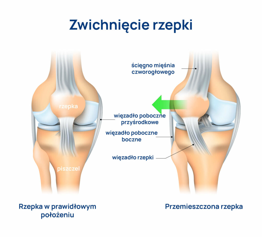 Zwichnięcie rzepki infografika