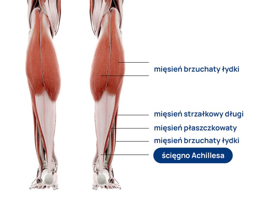 ból ścięgna Achillesa infografika